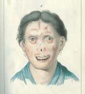 Illustration of a woman with facial lesions