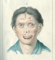 Illustration of a woman with facial lesions