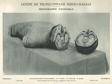 Coupe de troncÌ§onnage meÌdio-nasale